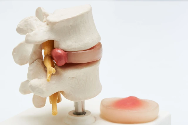 bulging disc vs herniated discimage