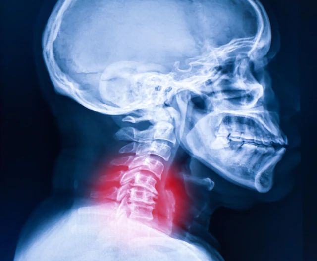 cervical pain issues