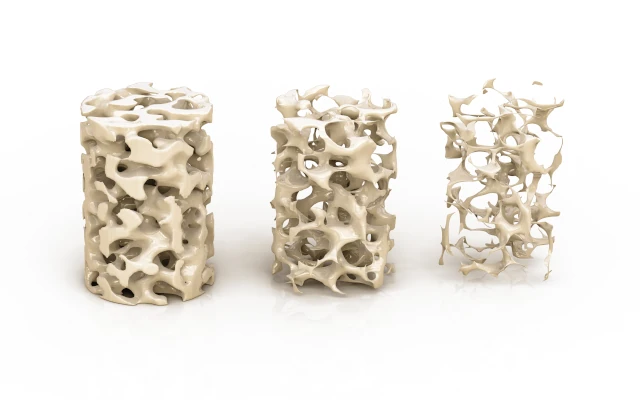 osteoporosis image