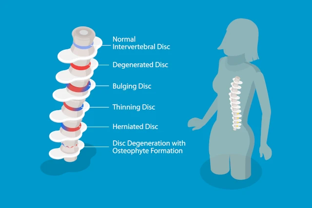 spinal disc types image