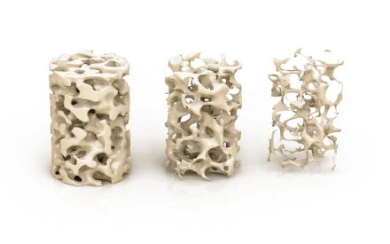 osteoporosis osteoporosis image